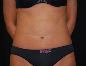 Liposuction Before & After Patient #22977