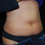 Liposuction Before & After Patient #22977