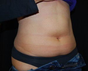 Liposuction Before & After Patient #22977