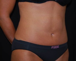 Liposuction Before & After Patient #22977