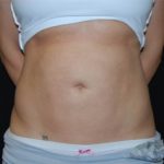 Liposuction Before & After Patient #23085