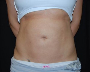 Liposuction Before & After Patient #23085