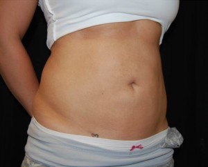 Liposuction Before & After Patient #23085