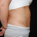 Liposuction Before & After Patient #23085