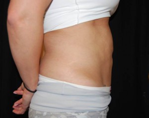 Liposuction Before & After Patient #23085