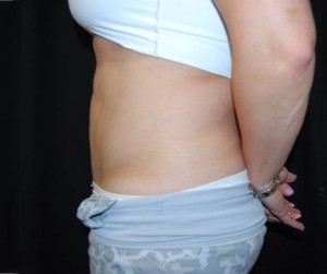 Liposuction Before & After Patient #23085