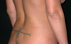 Liposuction Before & After Patient #23122