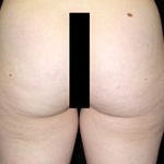 Liposuction Before & After Patient #23132