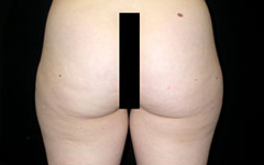 Liposuction Before & After Patient #23132