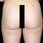 Liposuction Before & After Patient #23132