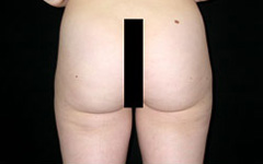 Liposuction Before & After Patient #23132