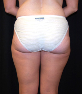 Liposuction Before & After Patient #23141