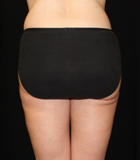 Liposuction Before & After Patient #23141