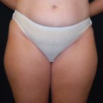 Liposuction Before & After Patient #23141