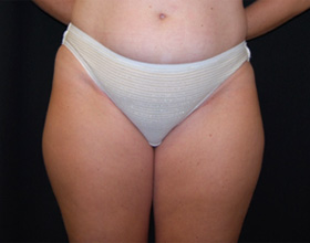 Liposuction Before & After Patient #23141