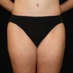 Liposuction Before & After Patient #23141