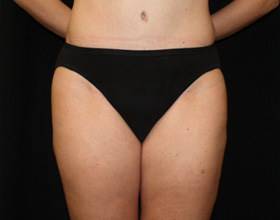 Liposuction Before & After Patient #23141