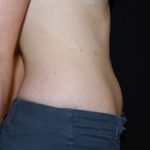 Liposuction Before & After Patient #23165