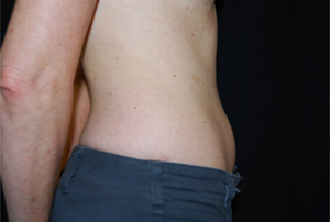 Liposuction Before & After Patient #23165