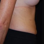 Liposuction Before & After Patient #23165