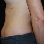 Liposuction Before & After Patient #23165