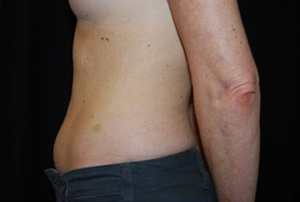 Liposuction Before & After Patient #23165