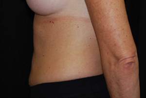 Liposuction Before & After Patient #23165