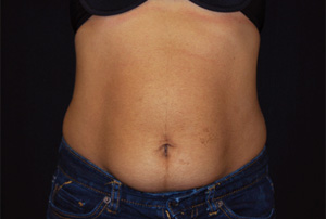 Liposuction Before & After Patient #23181