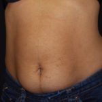 Liposuction Before & After Patient #23181