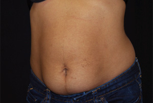 Liposuction Before & After Patient #23181