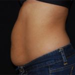Liposuction Before & After Patient #23181