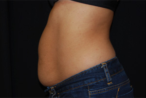 Liposuction Before & After Patient #23181