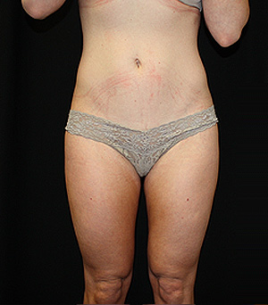 Liposuction Before & After Patient #23199
