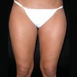 Liposuction Before & After Patient #23204