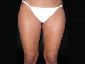 Liposuction Before & After Patient #23204