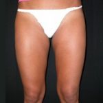 Liposuction Before & After Patient #23204