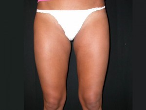 Liposuction Before & After Patient #23204