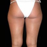 Liposuction Before & After Patient #23204