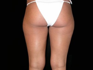 Liposuction Before & After Patient #23204