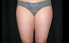 Liposuction Before & After Patient #23209