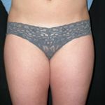 Liposuction Before & After Patient #23209