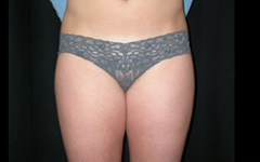 Liposuction Before & After Patient #23209