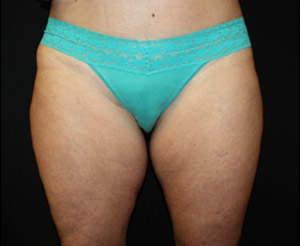 Liposuction Before & After Patient #23216