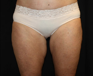 Liposuction Before & After Patient #23216