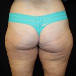 Liposuction Before & After Patient #23216