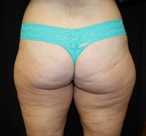 Liposuction Before & After Patient #23216