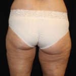 Liposuction Before & After Patient #23216