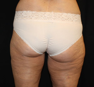 Liposuction Before & After Patient #23216