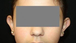 Otoplasty Before & After Patient #21512