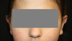 Otoplasty Before & After Patient #21512